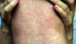 Waspadai Campak pada Anak!